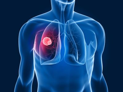 Lung cancer tumour