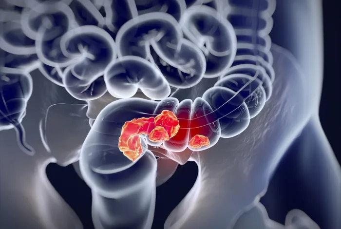 Long-read 16S rRNA amplicon sequencing reveals microbial characteristics in patients with colorectal adenomas and carcinoma lesions in Egypt