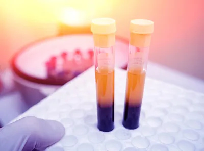 two vacutainers held with a gloved hand containing separated blood