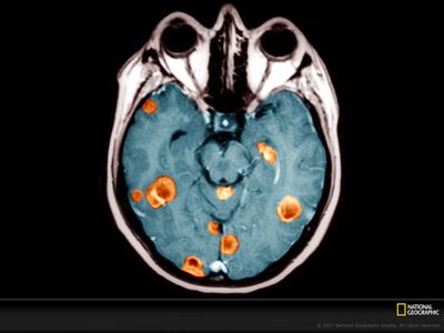 Same-day genomic and epigenomic diagnosis of brain tumors using real-time nanopore sequencing