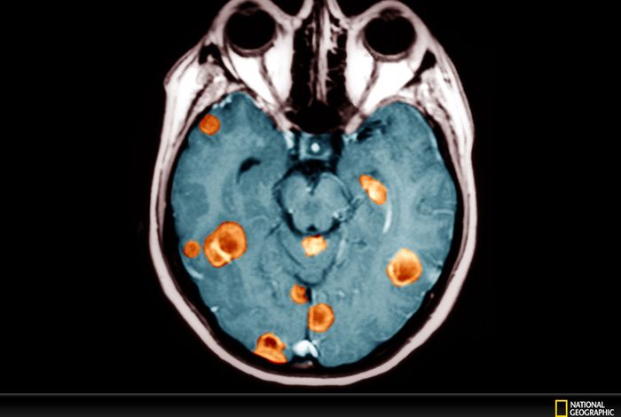 ROBIN: A unified nanopore-based assay integrating intraoperative methylome classification and next-day comprehensive profiling for ultra-rapid tumour