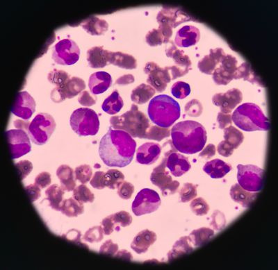 Leukemic cells