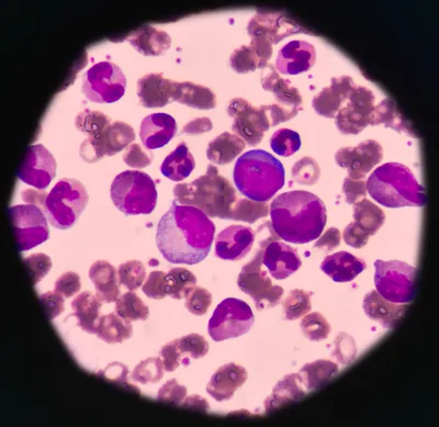 Leukemic cells