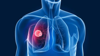 A rare case report of *Prevotella* lung abscess diagnosed using third-generation metagenomic sequencing