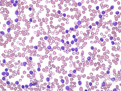 Lymphocytic Leukaemia Histology