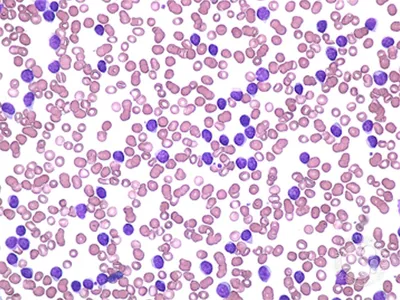 Lymphocytic Leukaemia Histology