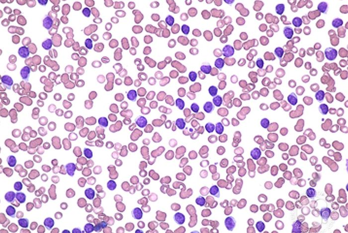 TP53 gene mutation analysis in chronic lymphocytic leukemia by nanopore MinION sequencing