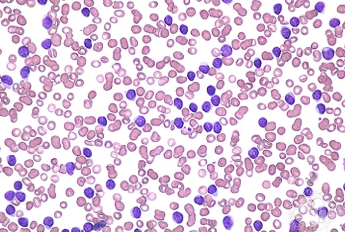 TP53 gene mutation analysis in chronic lymphocytic leukemia by nanopore MinION sequencing