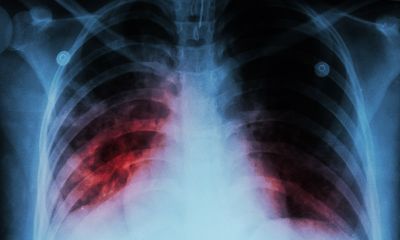 Tuberculosis chest X-ray