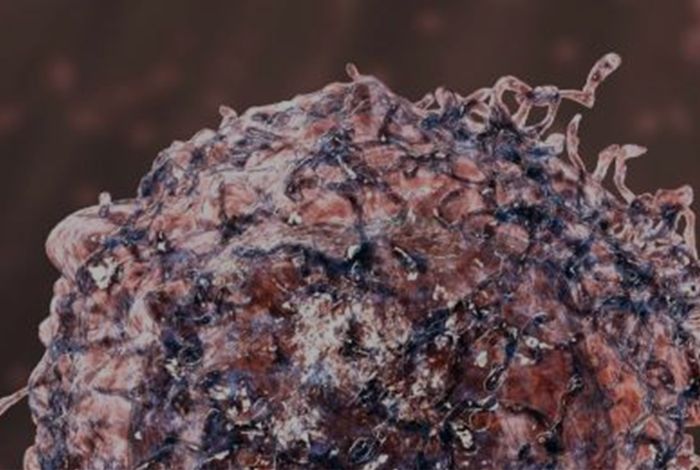 Concurrent L1 retrotransposition events promote reciprocal translocations in human tumorigenesis