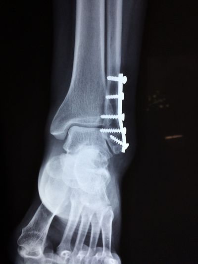 Ankle medical implant