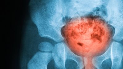 MinION for rapid identification of Urinary Tract Infections