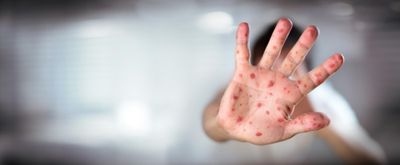 Varicella zoster - child's hand with chicken pox