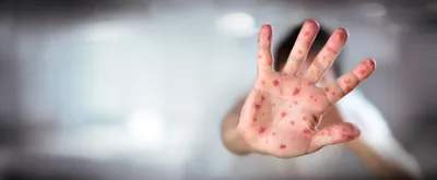 Varicella zoster - child's hand with chicken pox