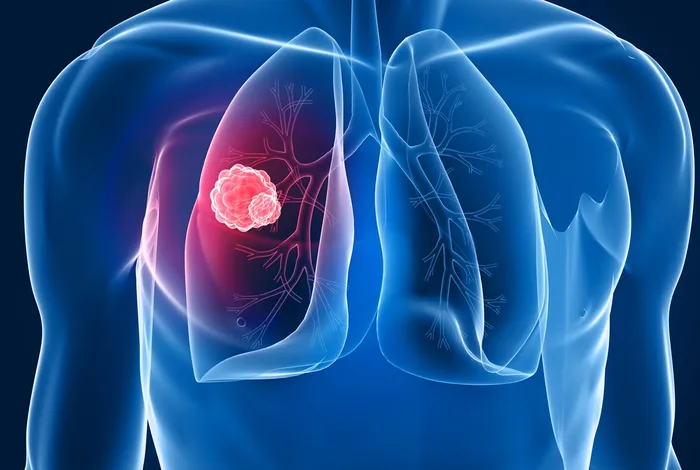 NCM 2021: Phasing analysis of lung cancer genomes using PromethION R10.4
