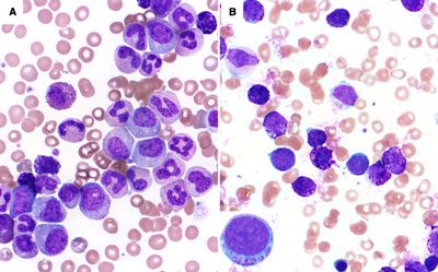 Mutational analysis in BCR-ABL1 positive leukemia by deep sequencing based on nanopore MinION technology