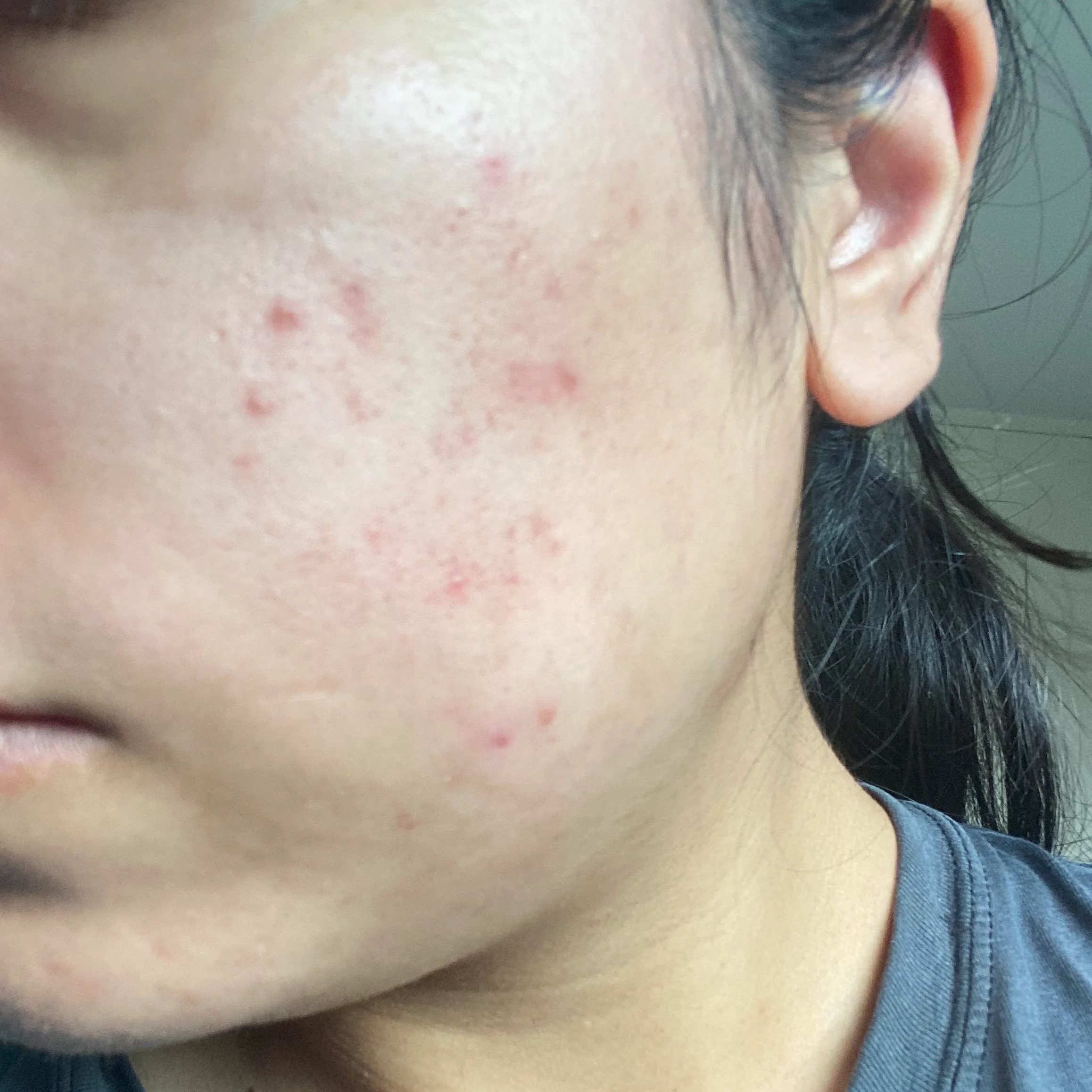 Understanding and Treating PostInflammatory Erythema (PIE) Renude