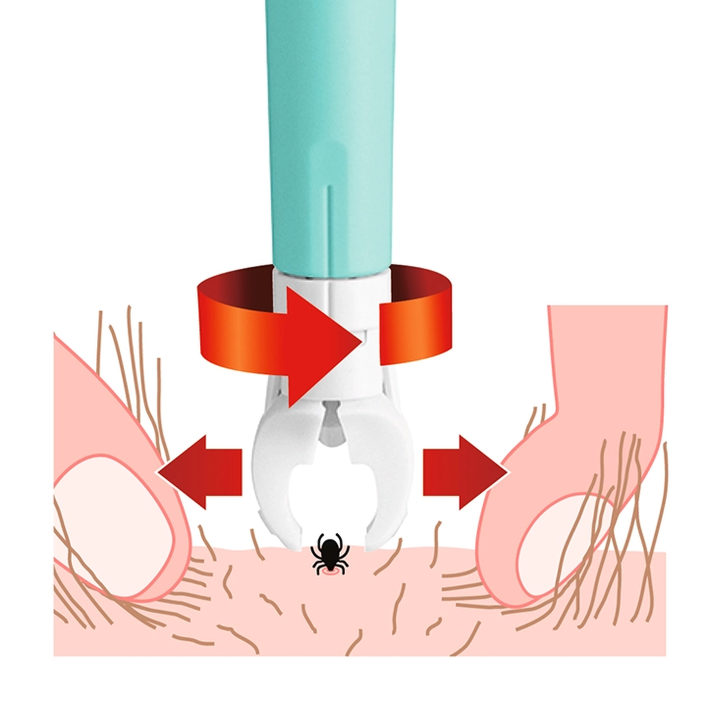 Abbildung eines Zeckenentfernungsinstruments mit blauem Griff, das zeigt, wie man eine Zecke mithilfe einer Drehbewegung mit einer weißen Klemme aus der Haut entfernt.