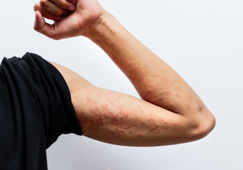 Atopische Dermatitis Ursache & Behandlungsmethoden