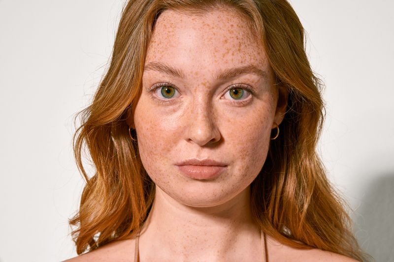 freckles-melasma