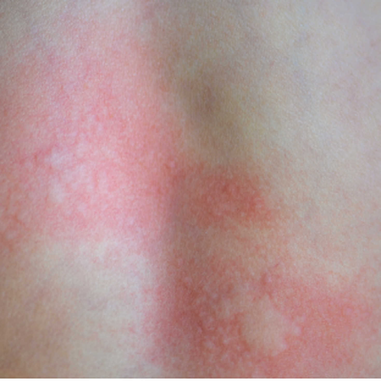 Rote Punkte auf der Haut diagnostizieren und behandeln