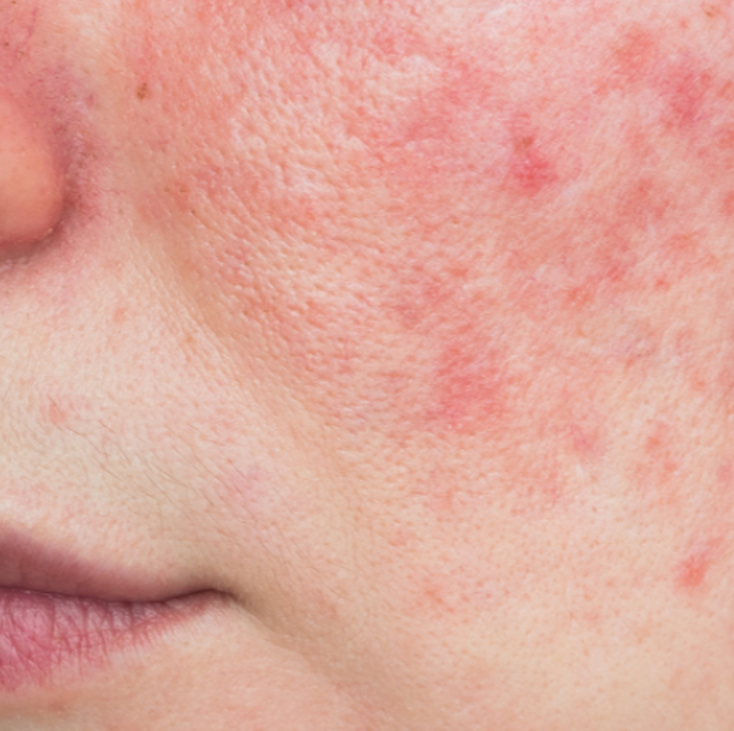 Rote Äderchen im Gesicht Couperose richtig behandeln