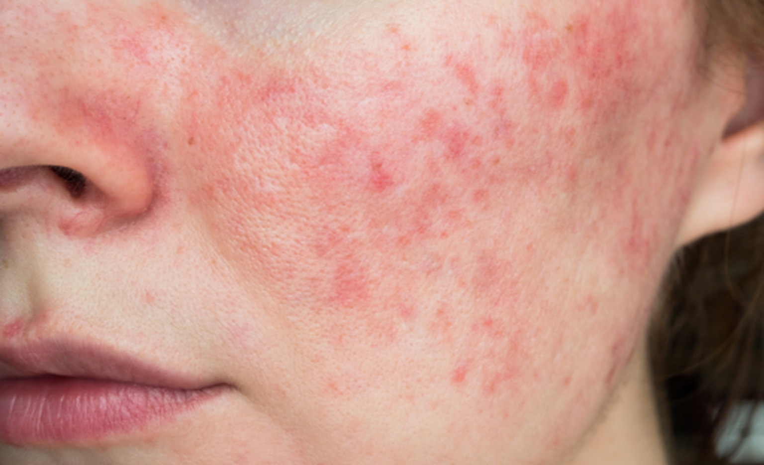 rosacea