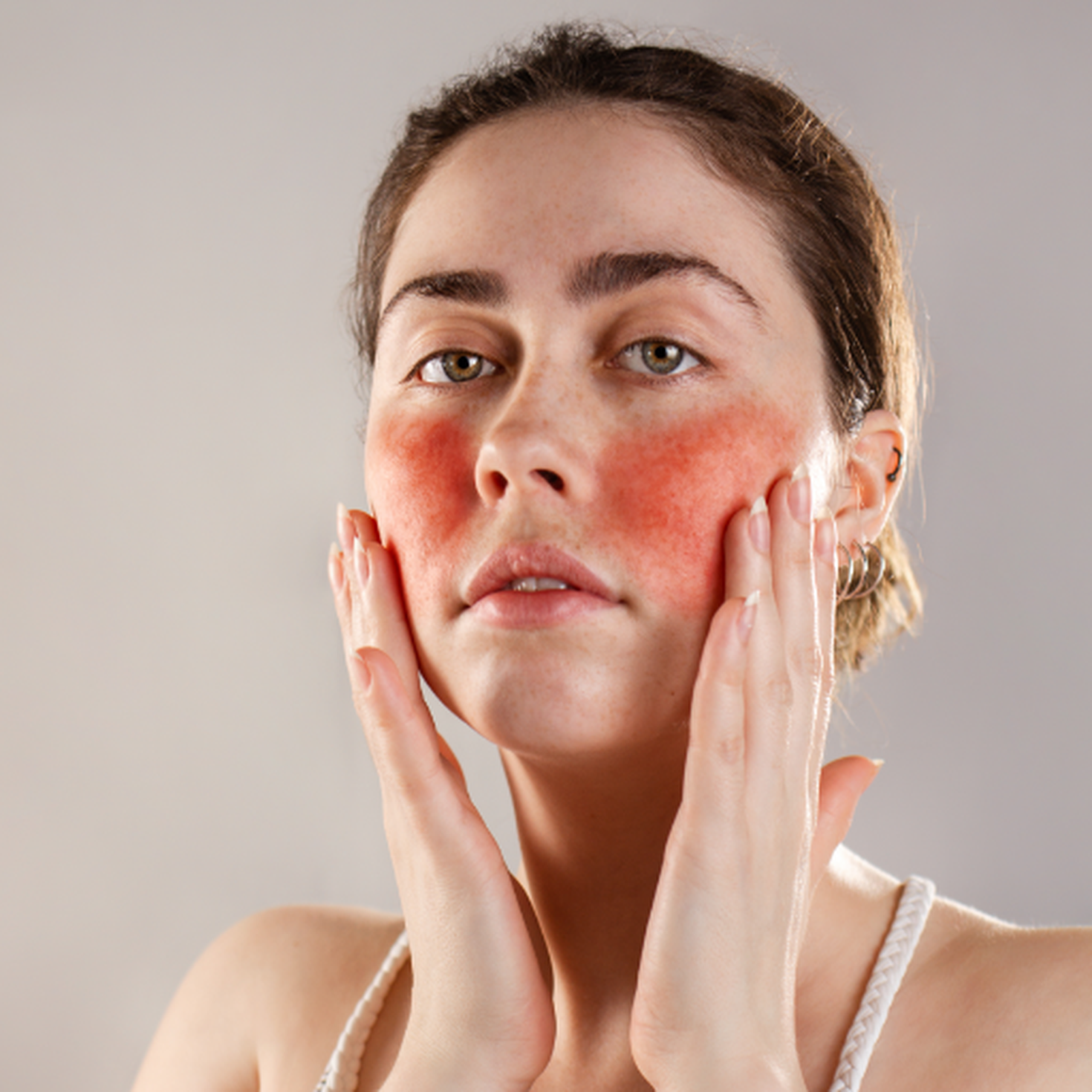 Rosacea erfahre mehr über die drei Krankheitsstadien