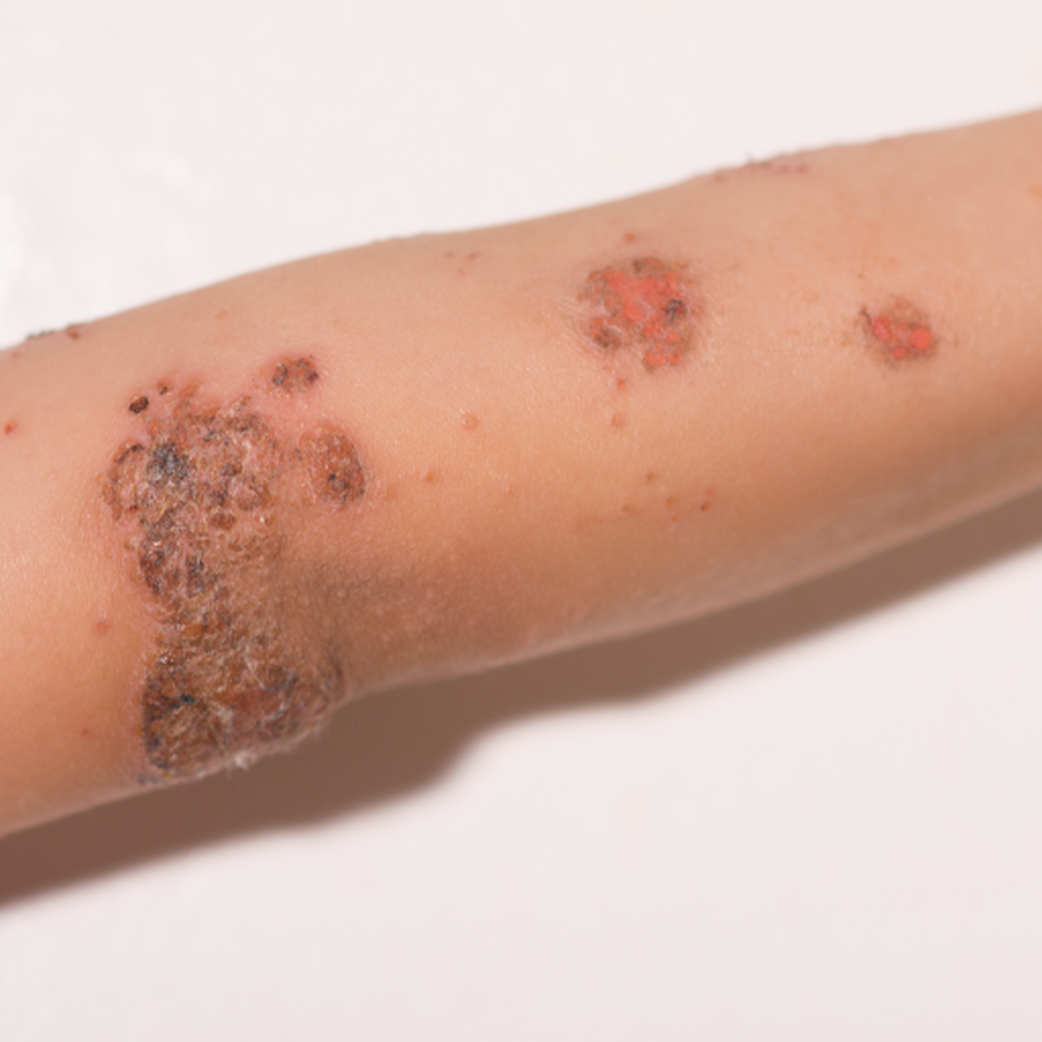 Impetigo Contagiosa Therapie erfahre hier mehr dazu