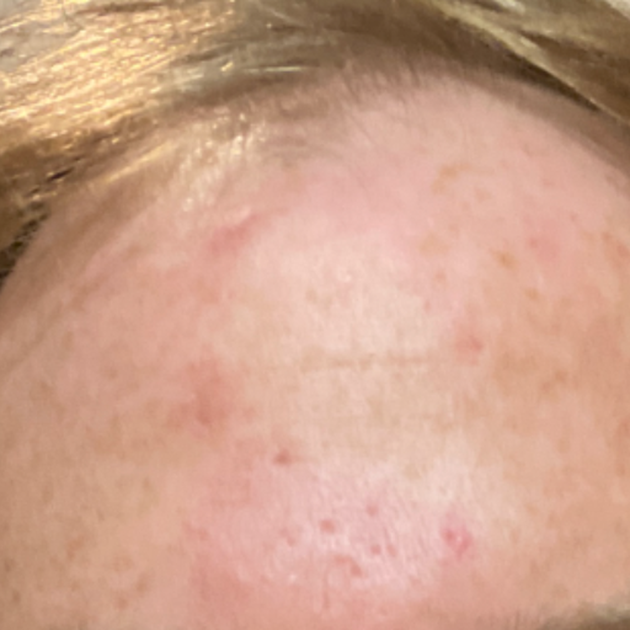 Rote Äderchen im Gesicht Couperose richtig behandeln