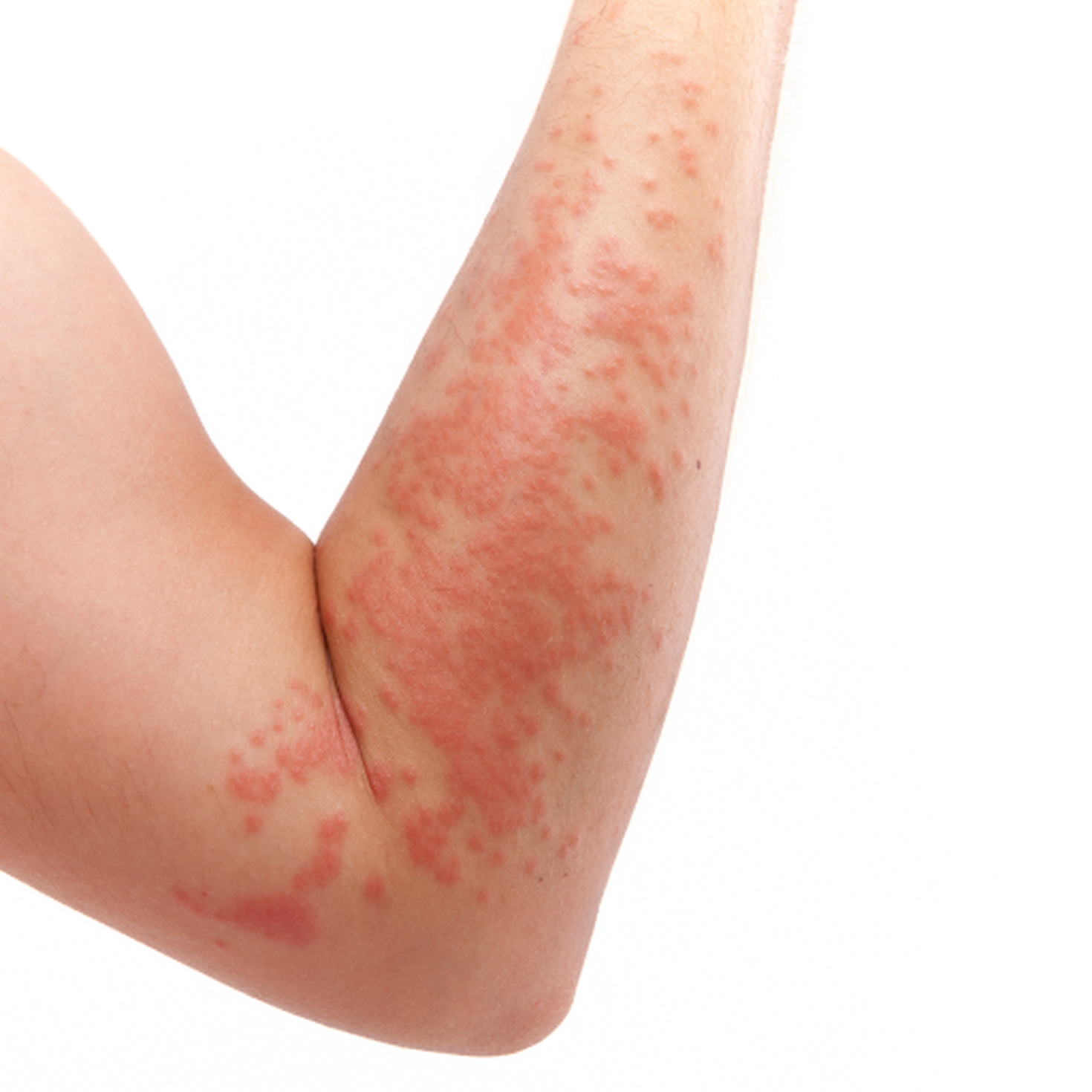 Sonnenallergie (Polymorphe Lichtdermatose) was hilft?
