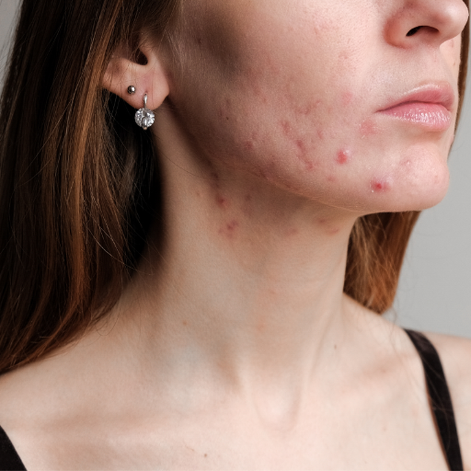 Hormonelle Akne wirksam behandeln – Jetzt informieren