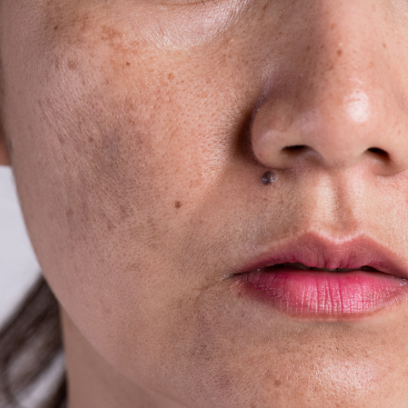melasma-schwangerschaft-1