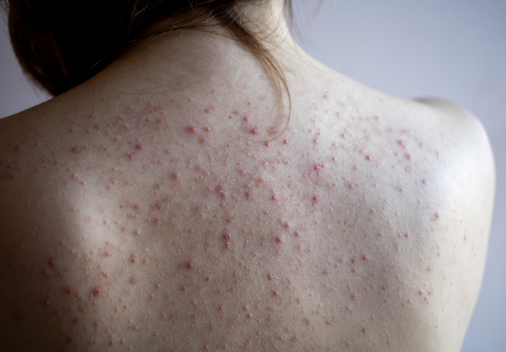 e-zigarette akne inversa Akne inversa: Therapieansätze geben Hoffnung main image 0