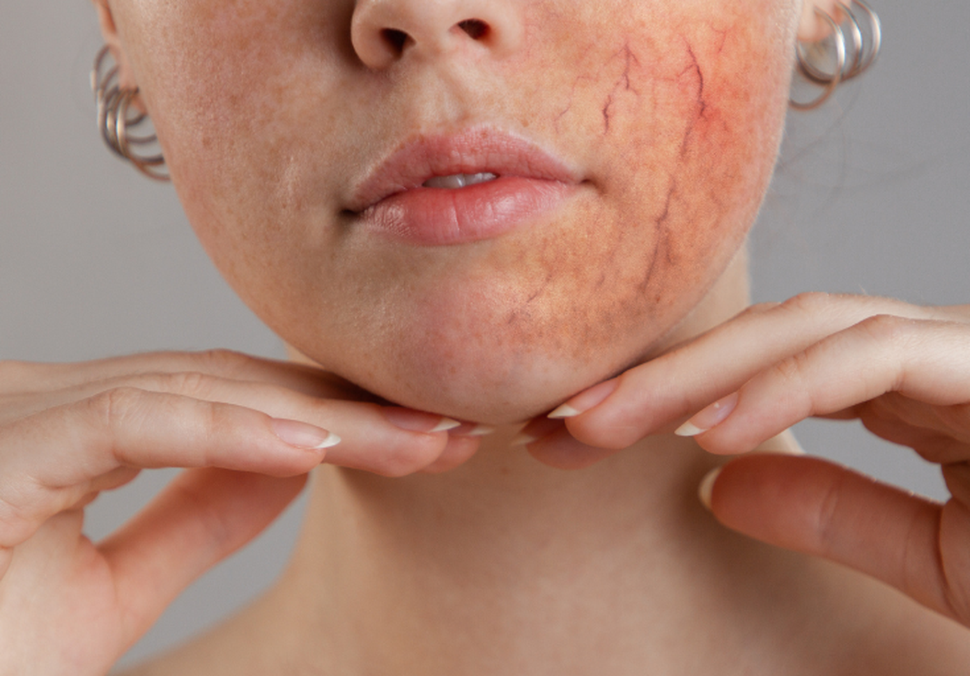 Individuelle RosaceaBehandlung Was Du tun kannst