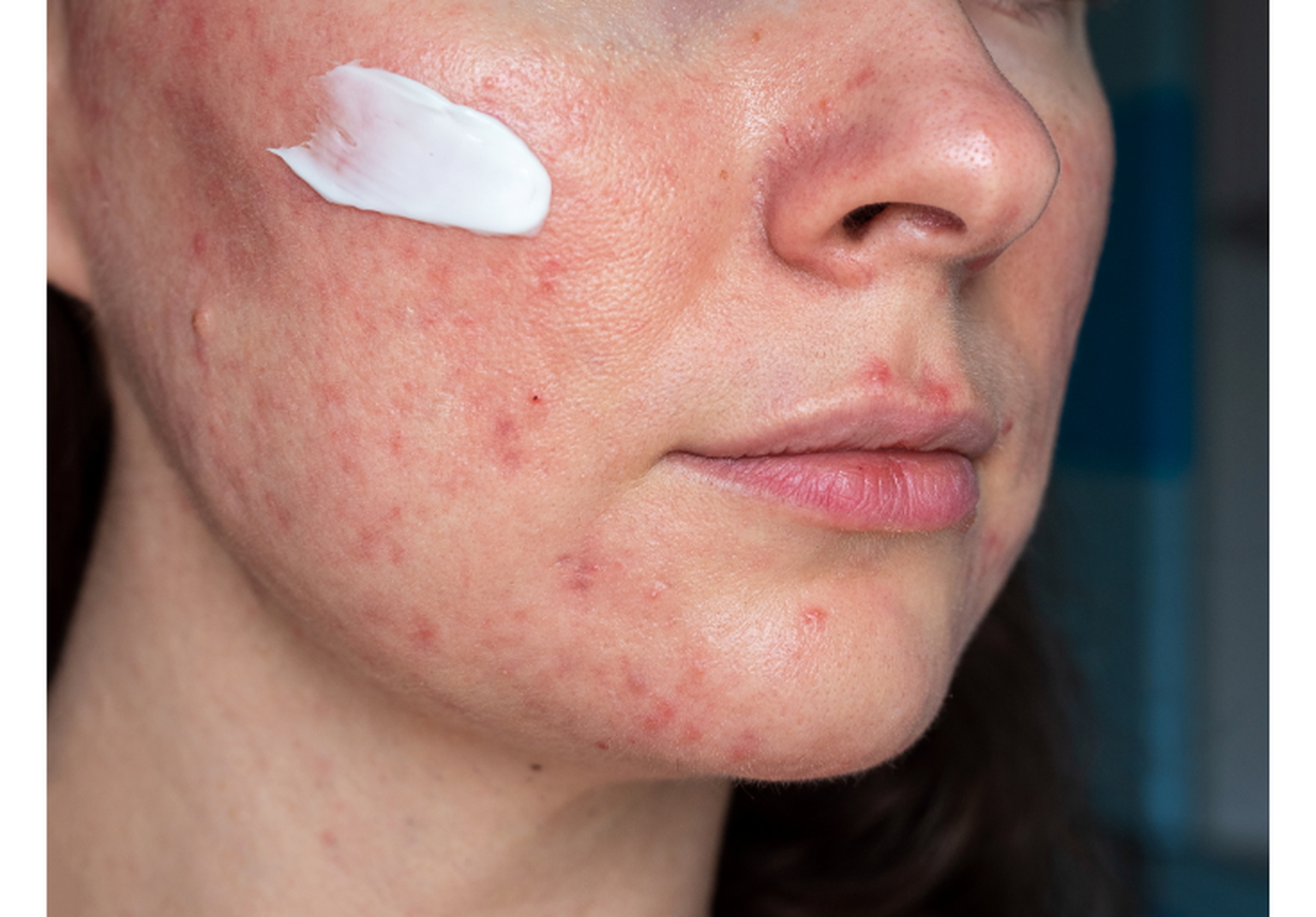 RosaceaCreme zuverlässige Hilfe bei Deinem Rosacea