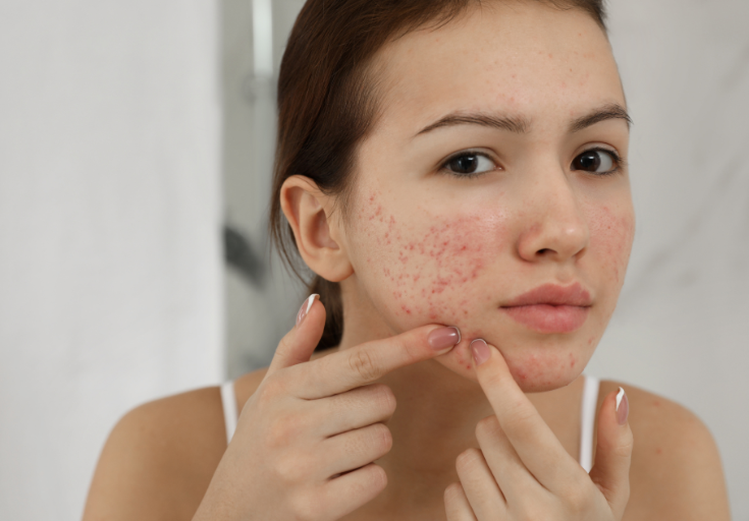 Pickel ausdrücken, Sucht? – Behandlung jetzt starten