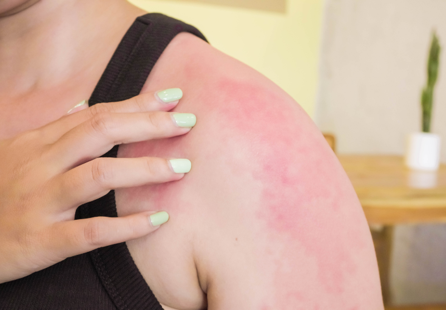 SonnenbrandGrad Symptome, Behandlung und Tipps