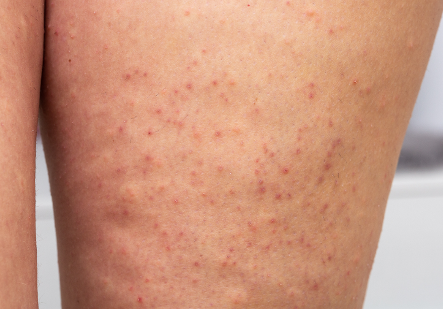 reibeisenhaut-keratosis-pilaris-jetzt-informieren