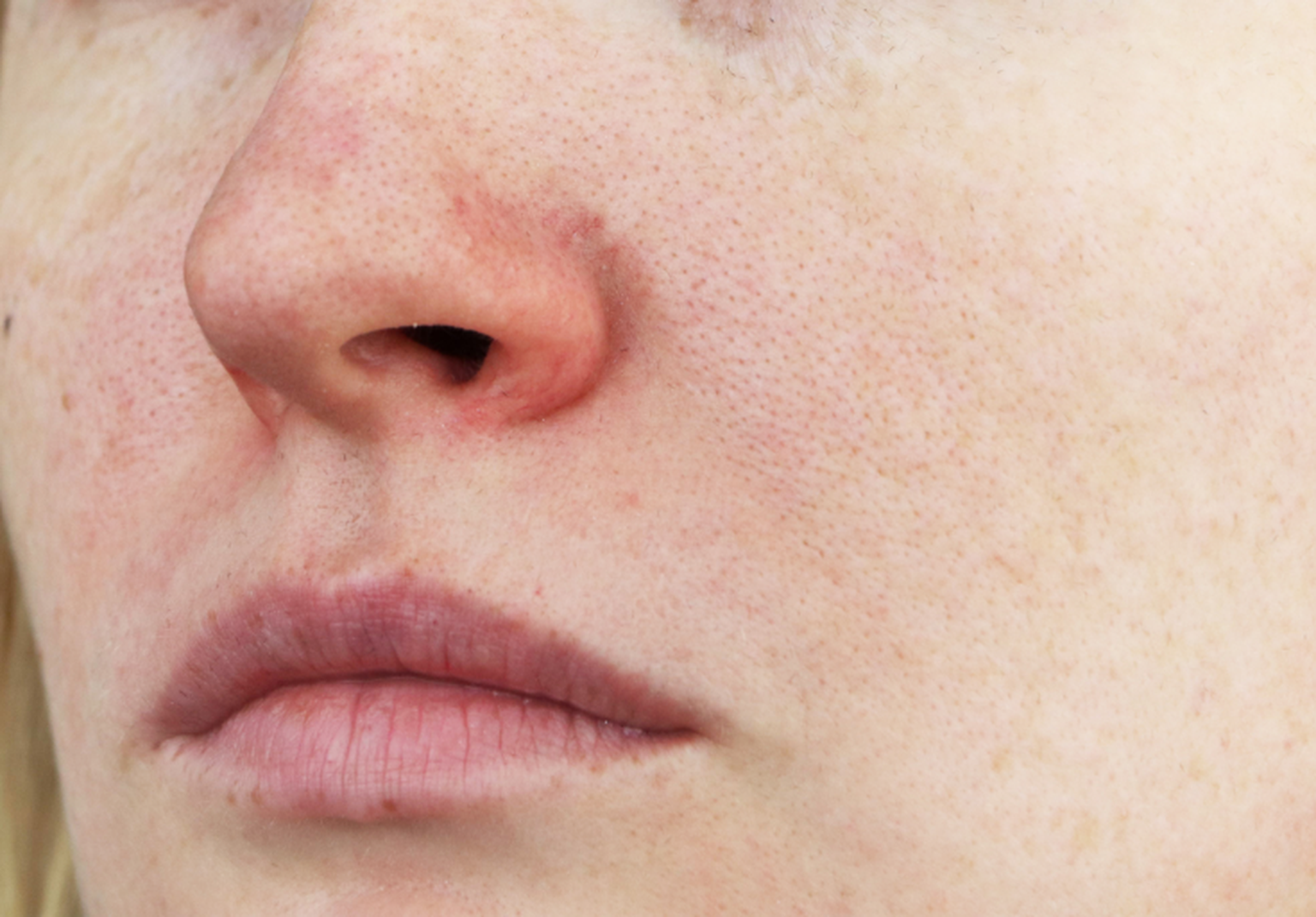 Rosacea auf der Nase Ursachen & Behandlungsmethoden