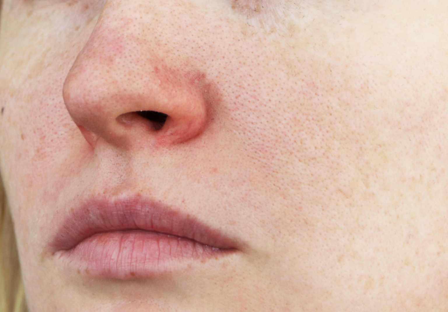 rosacea-nase