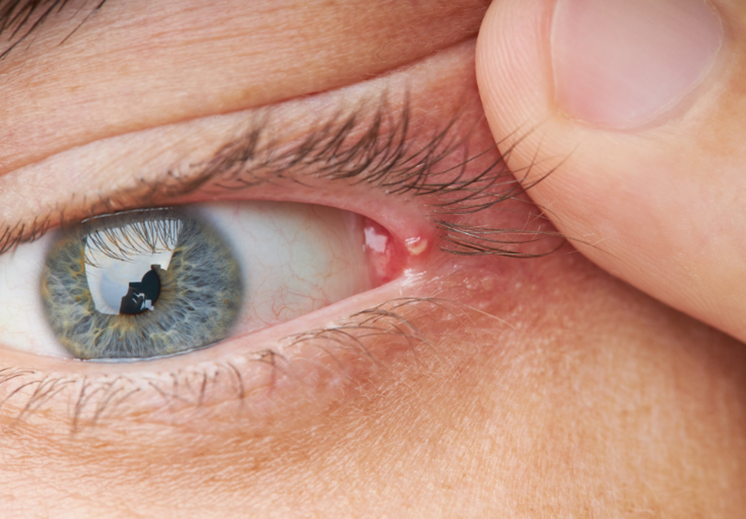 Pickel am Auge wirksam behandeln – mehr herausfinden