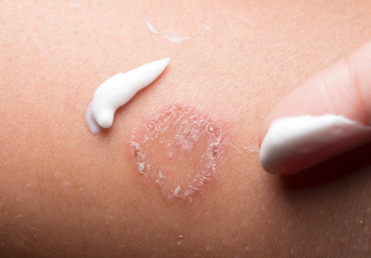 behandlung ringelflechte bilder