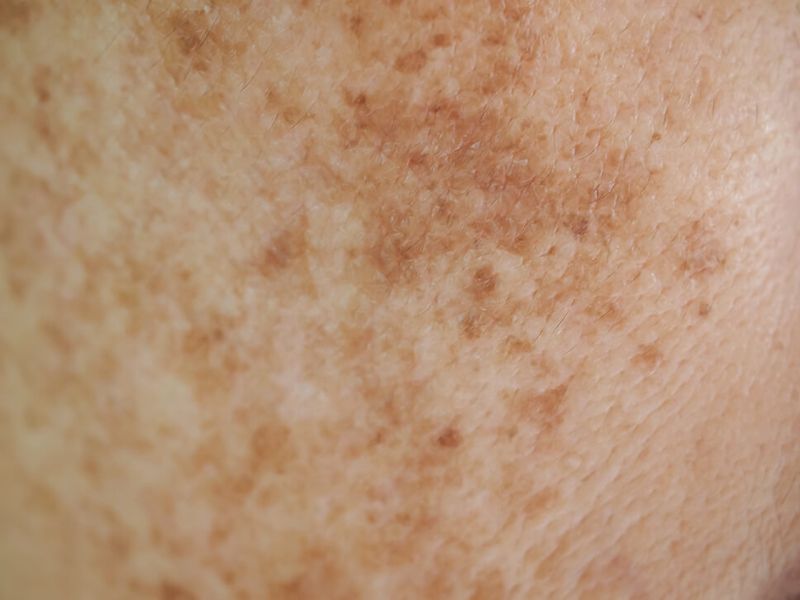 melasma_symptomatik2