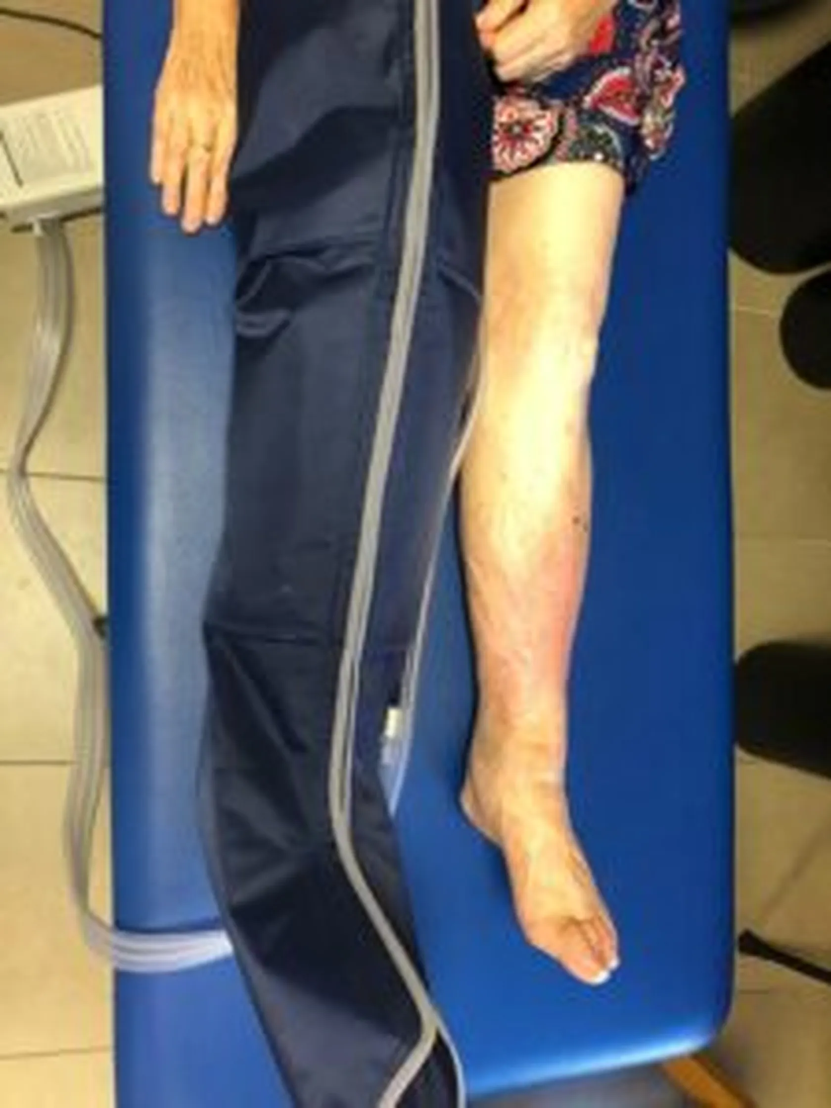 Presoterapia-2-225x300.jpg