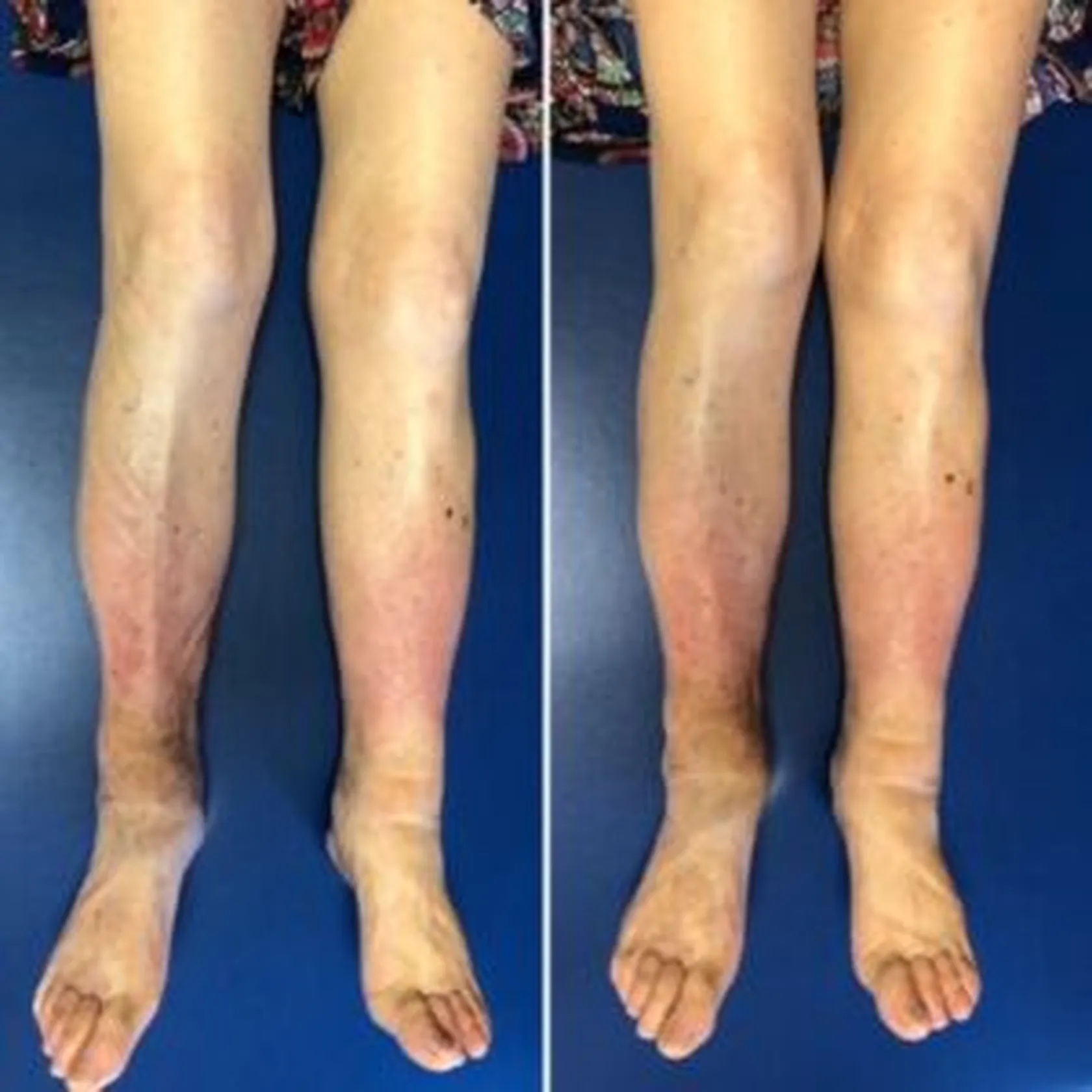 Presoterapia-3-300x300.jpg