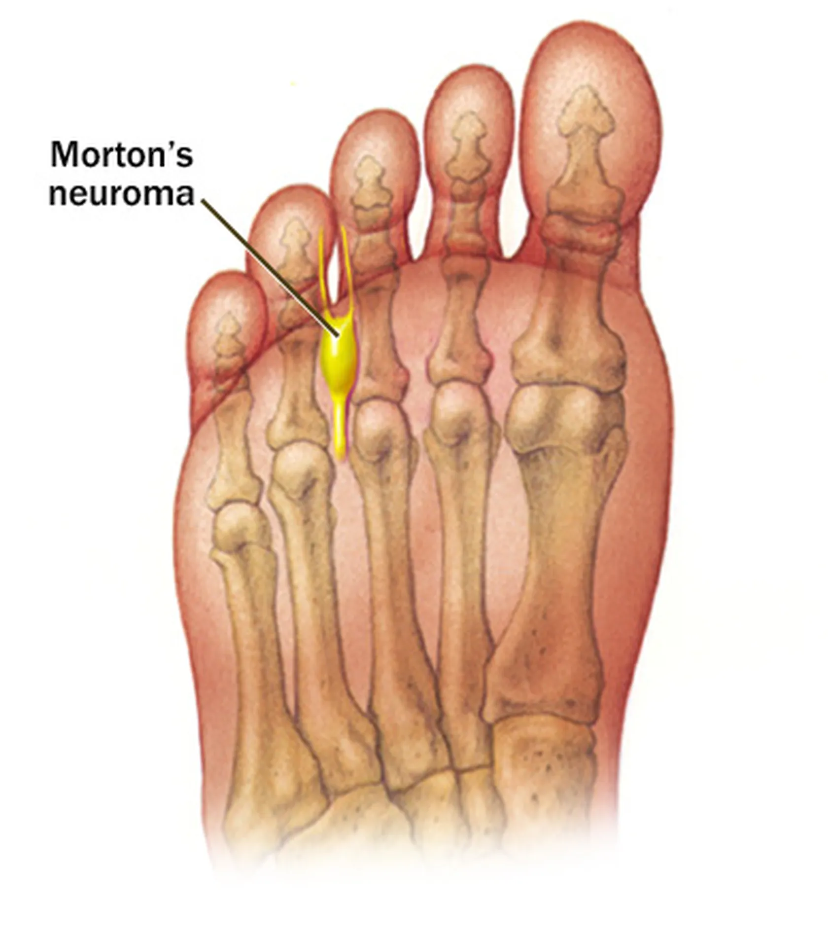Neuroma-de-morton-en-DomusVi-Alcalá-de-Guadaíra.jpg