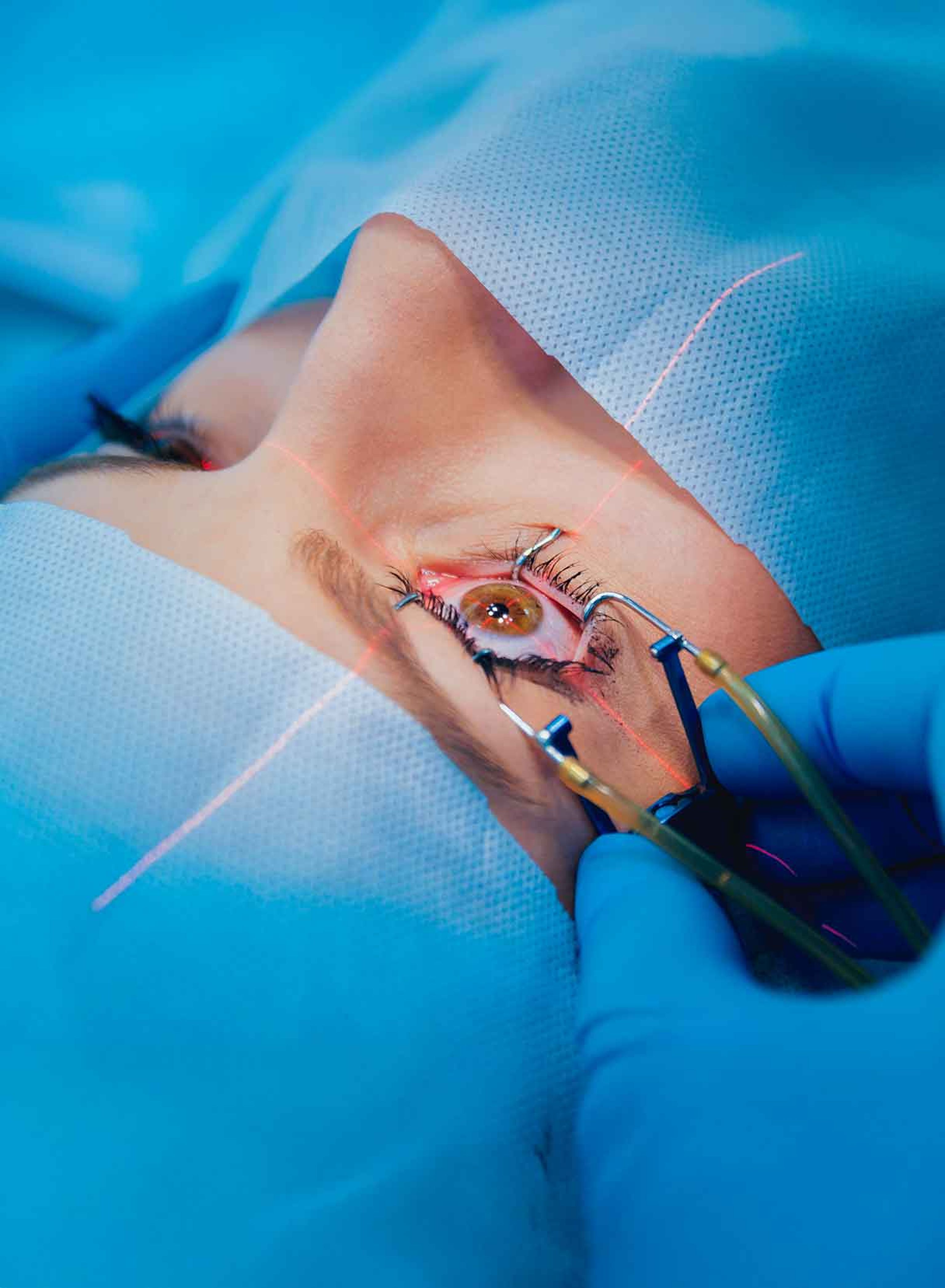 lenti intraoculari icl per intervento miopia e altri difetti visivi