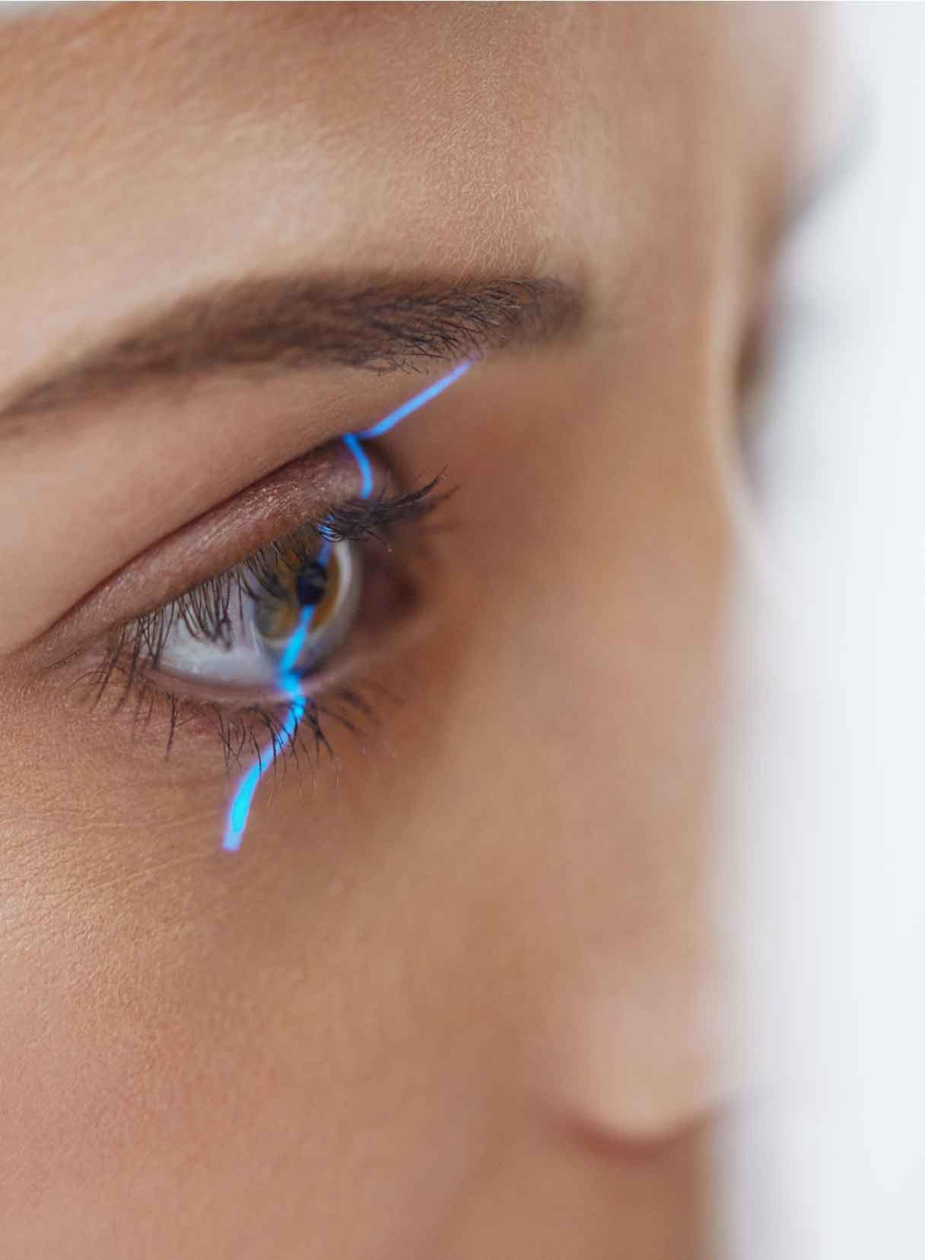 intervento laser agli occhi Femto-LASIK