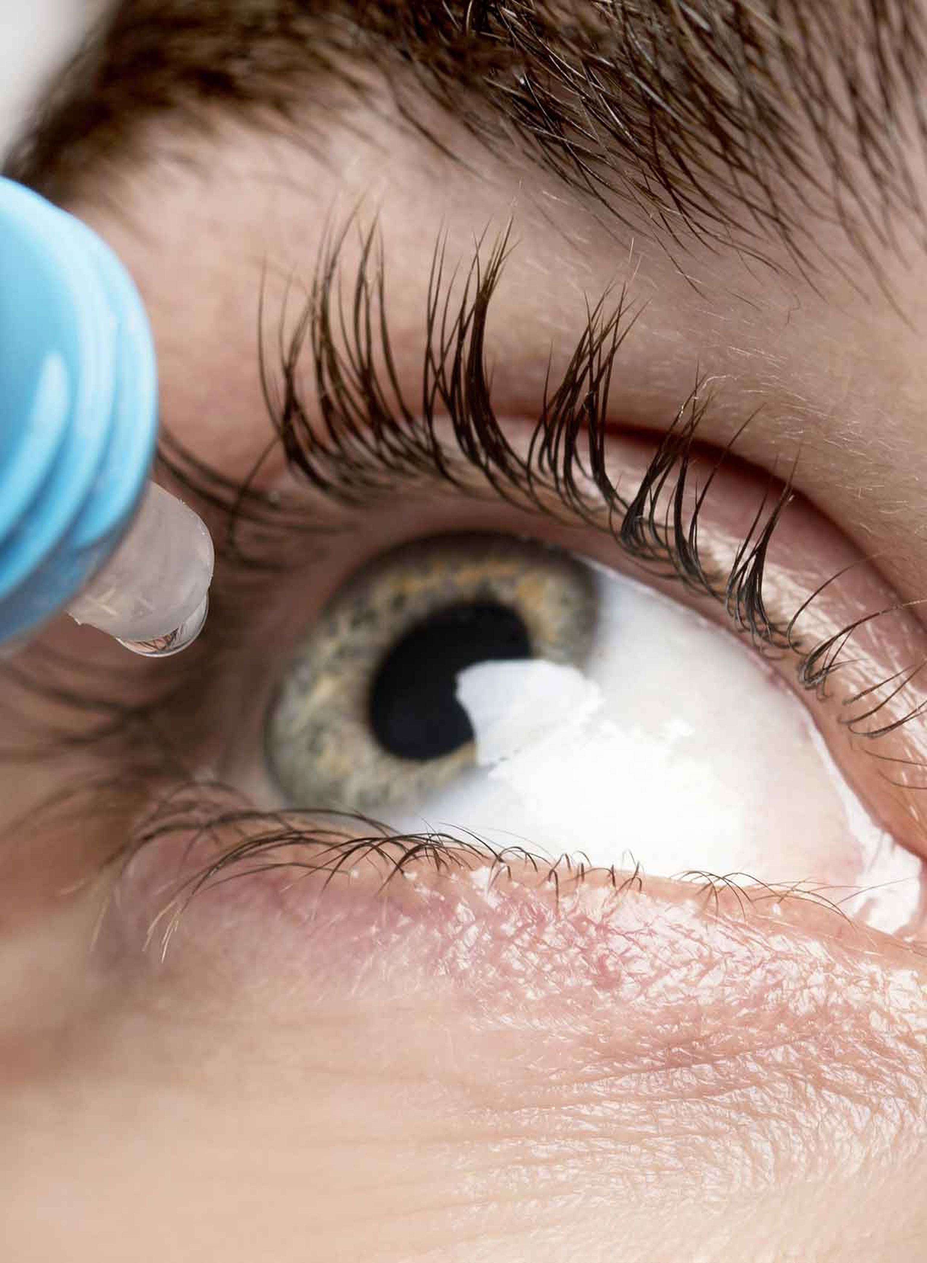 collirio applicato sull'occhio secco prima di un intervento laser occhi